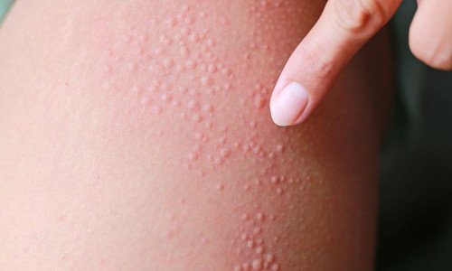 宝宝吃罗红霉素最多吃几天、幼儿罗红霉素 -宝宝 罗红霉素吃法网